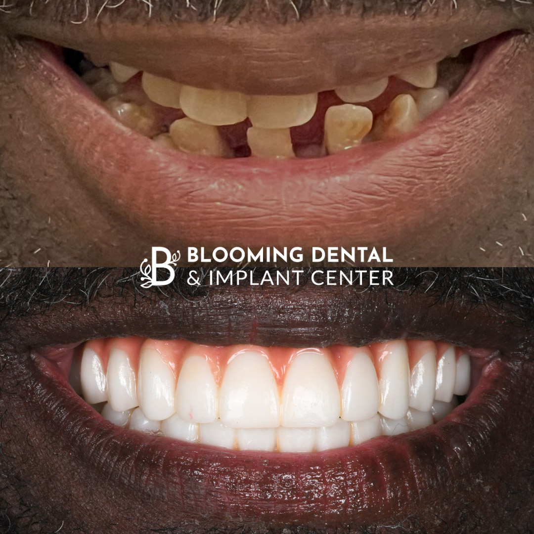 Full Mouth Dental Implant Image 97