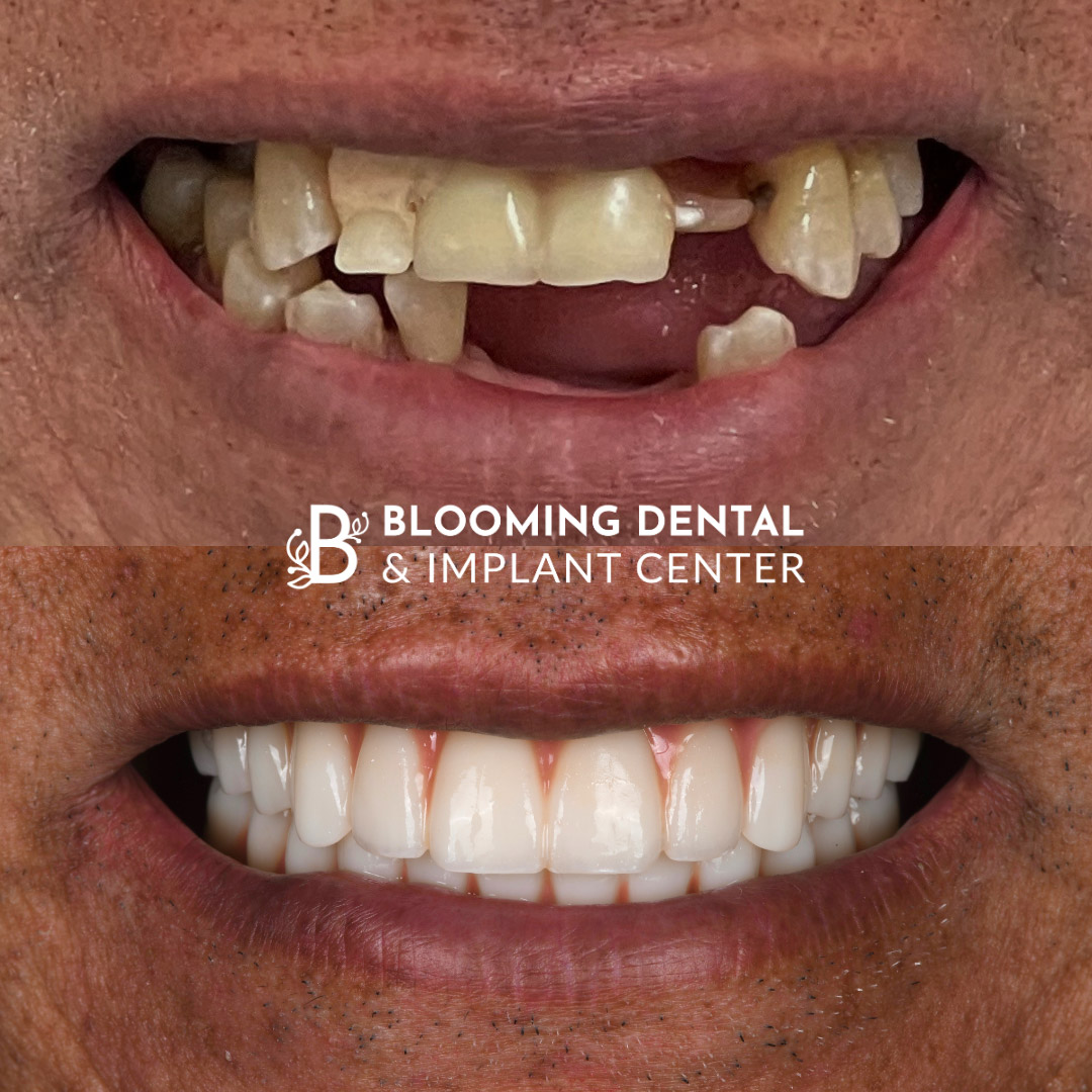 Full Mouth Dental Implant Image 98