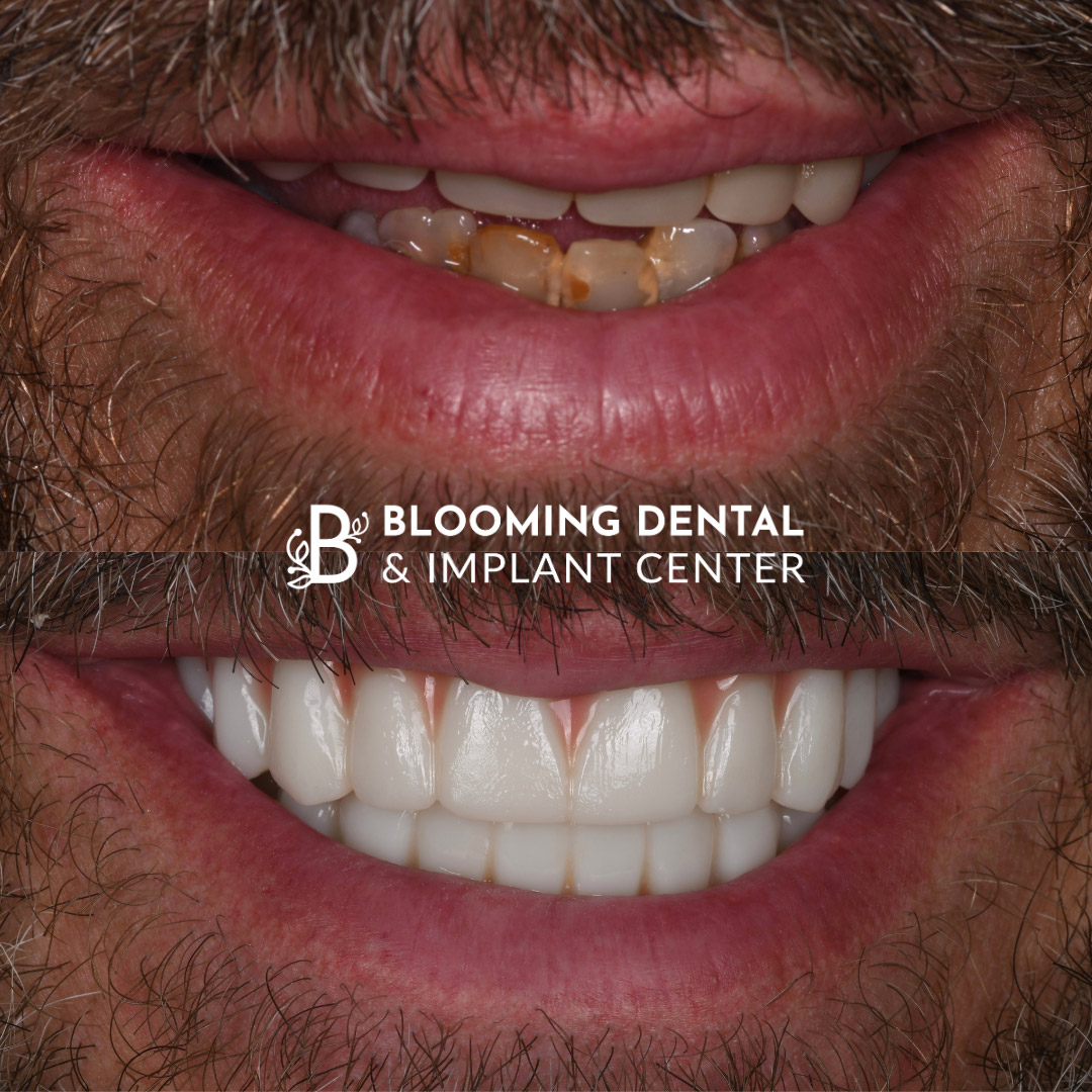 Full Mouth Dental Implant Image 99