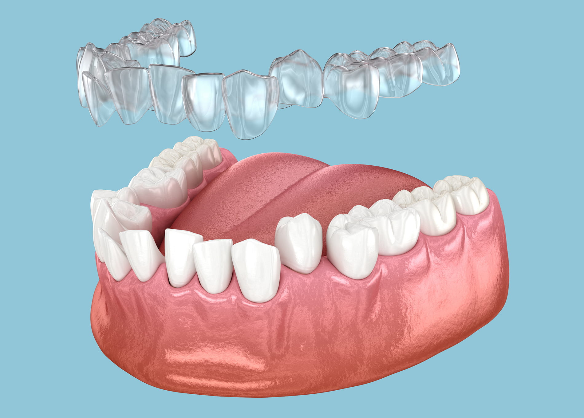 Invisalign treatment