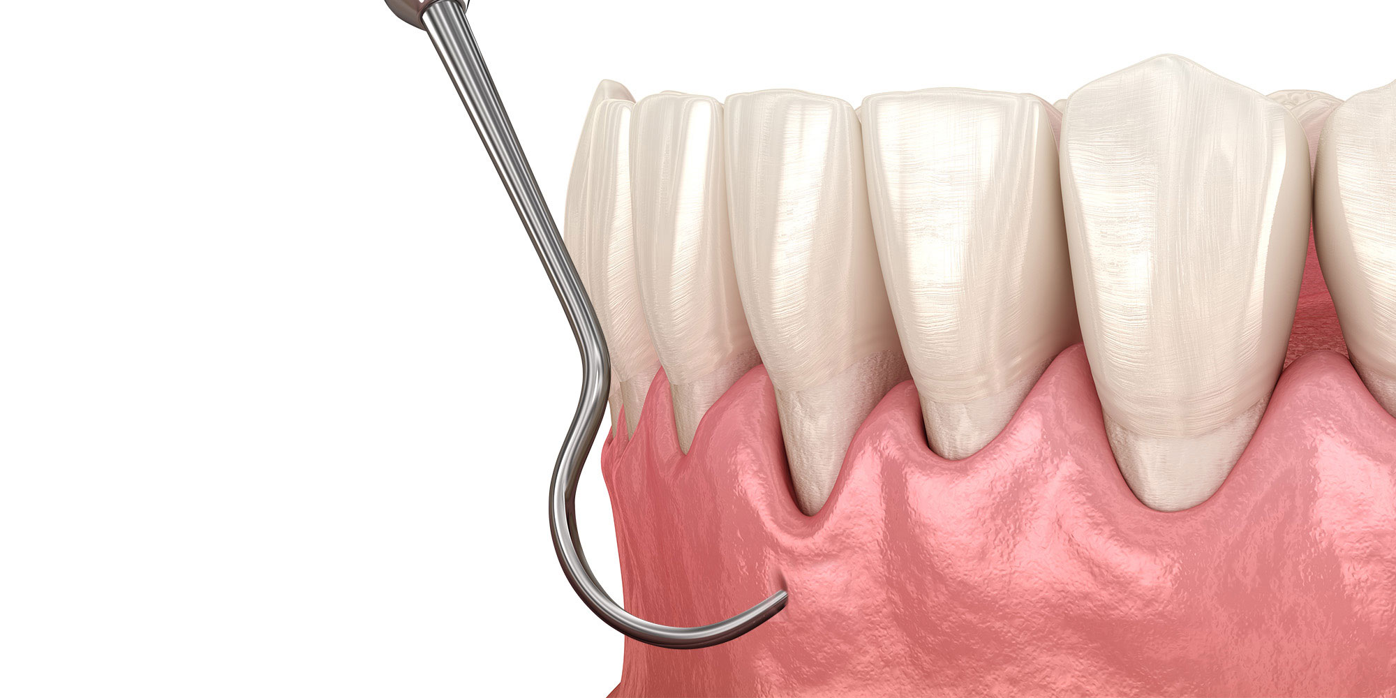 Pinhole Gum Grafting Banner