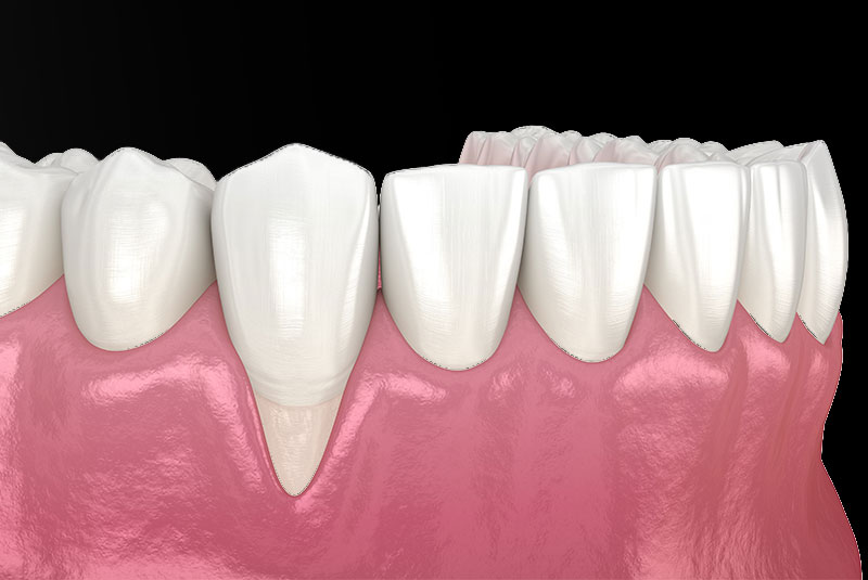 Receding Gum Surgery with PST