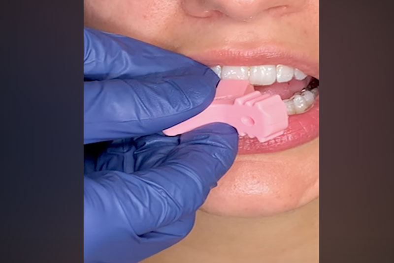 Aligner Munchies® Tutorial