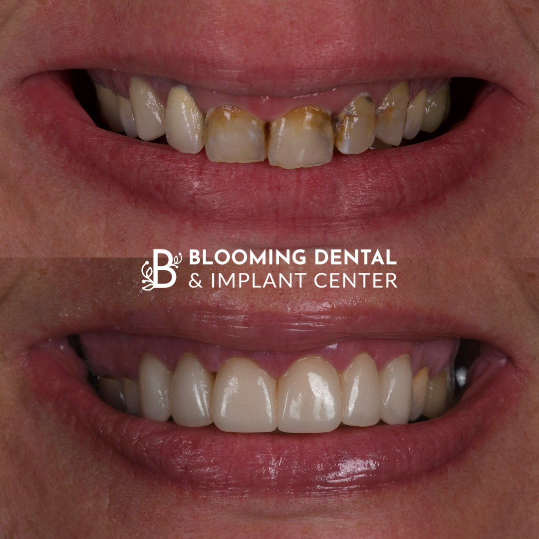 Veneers & FMR Image 10