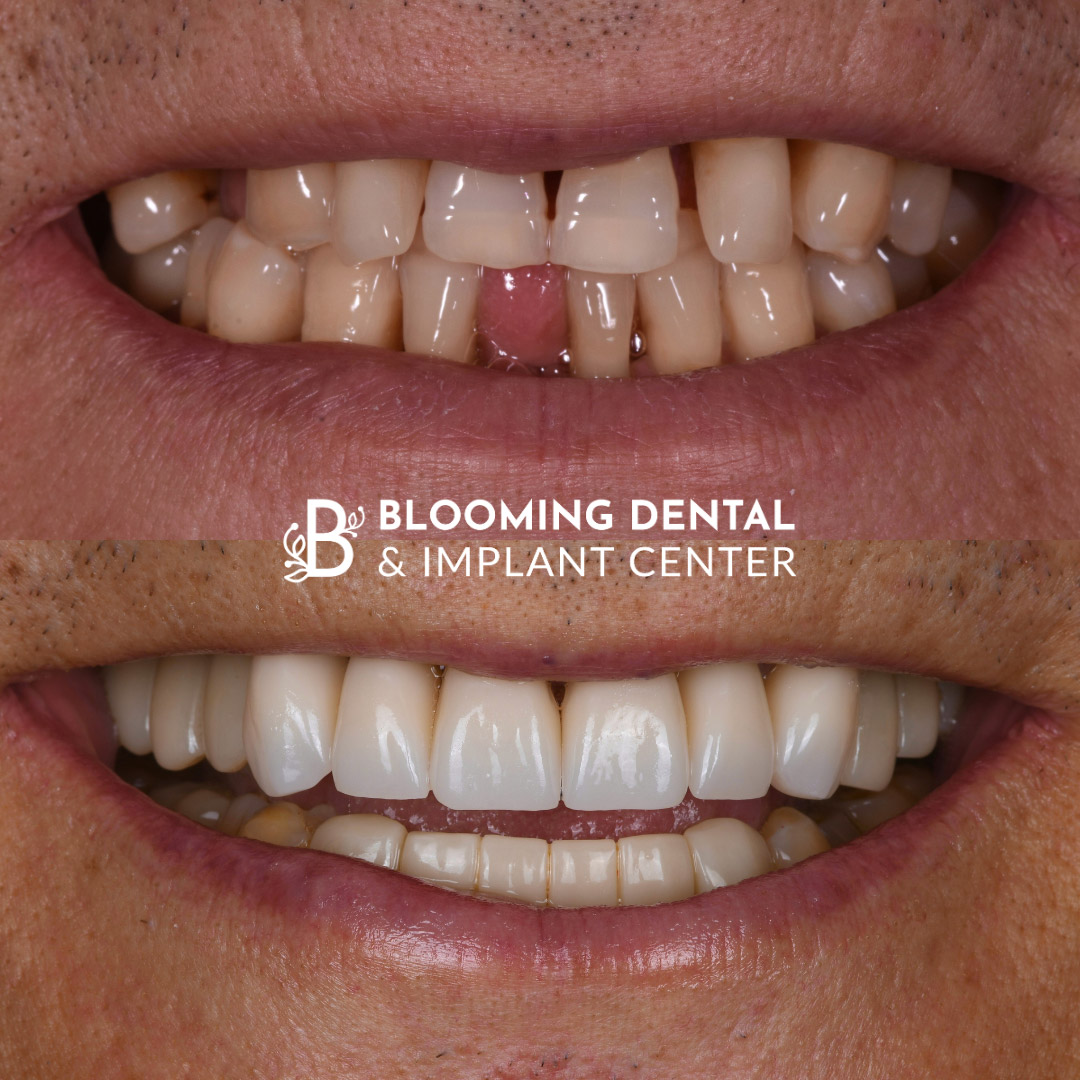 Veneers & FMR Image 11