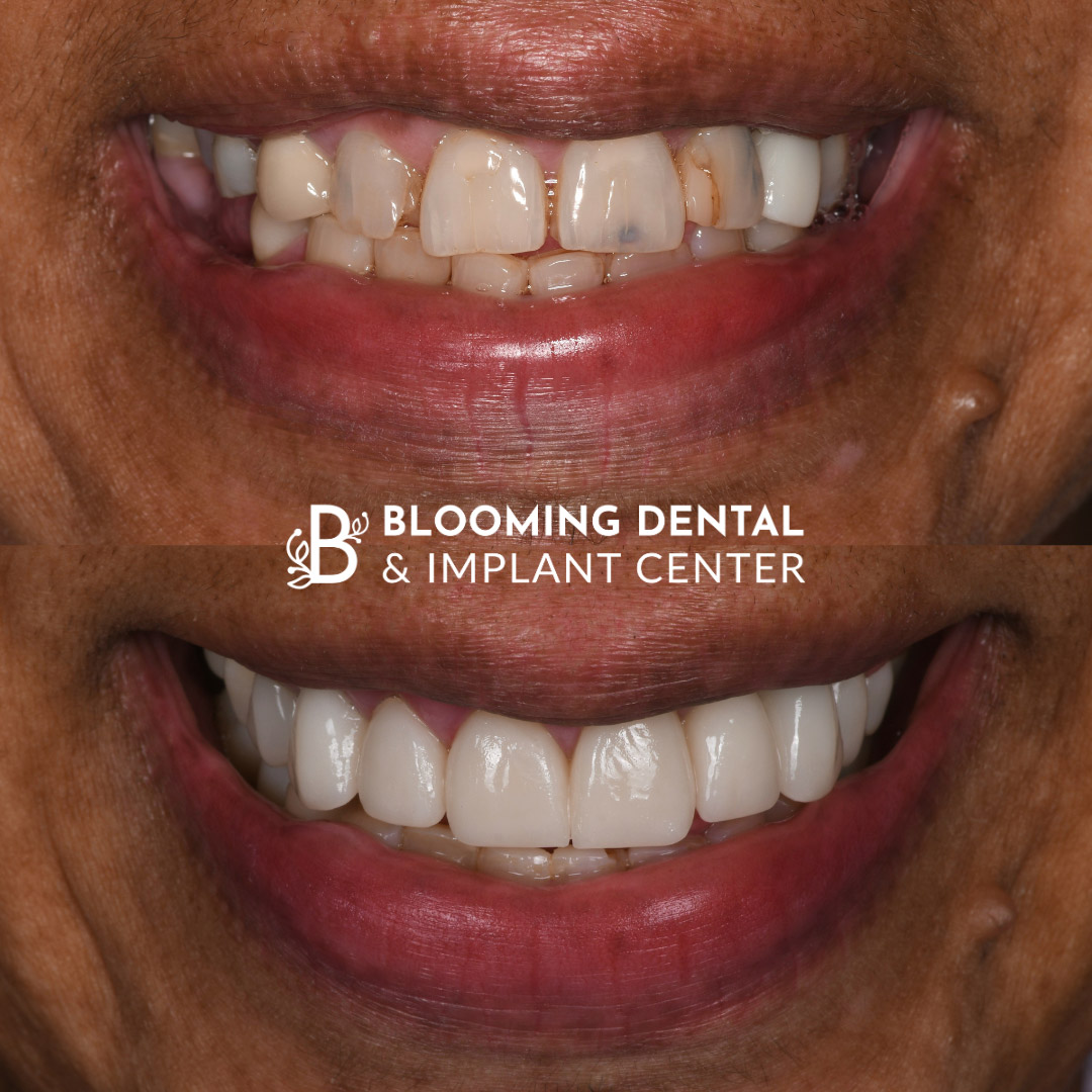 Veneers & FMR Image 12