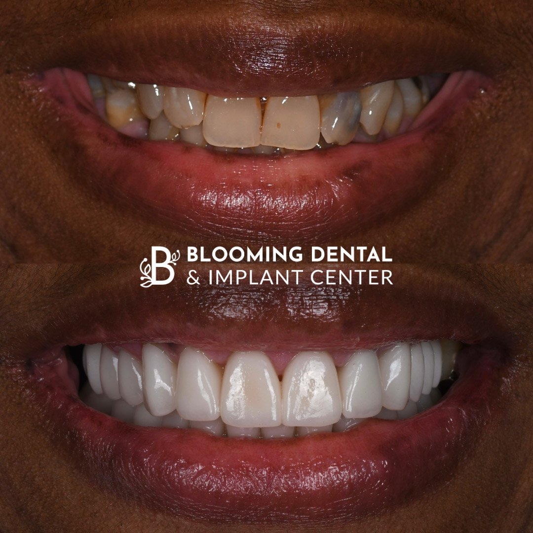 Veneers & FMR Image 13