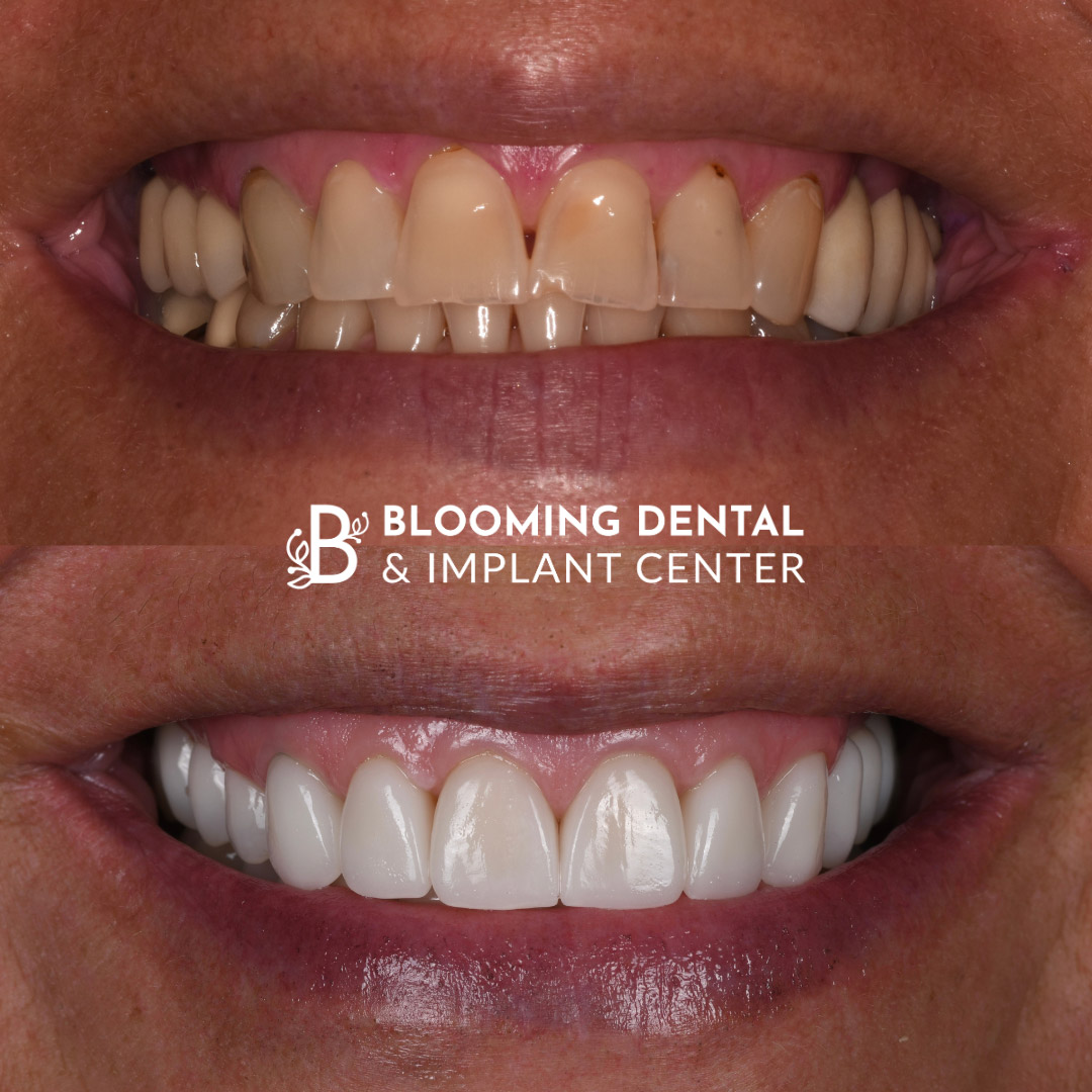 Veneers & FMR Image 14