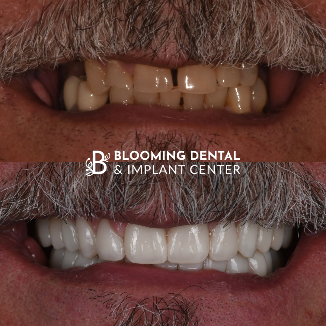 Veneers & FMR Image 15