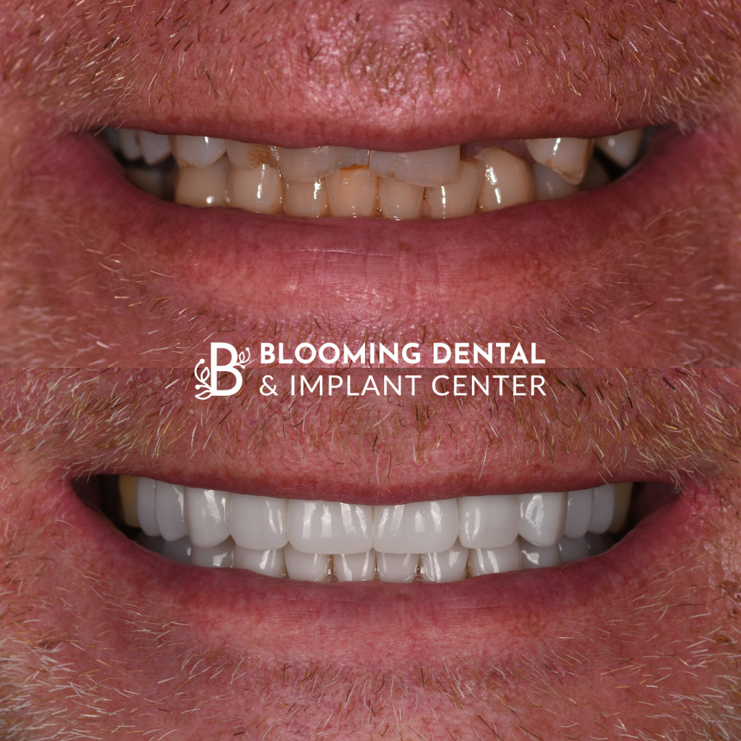 Veneers & FMR Image 16