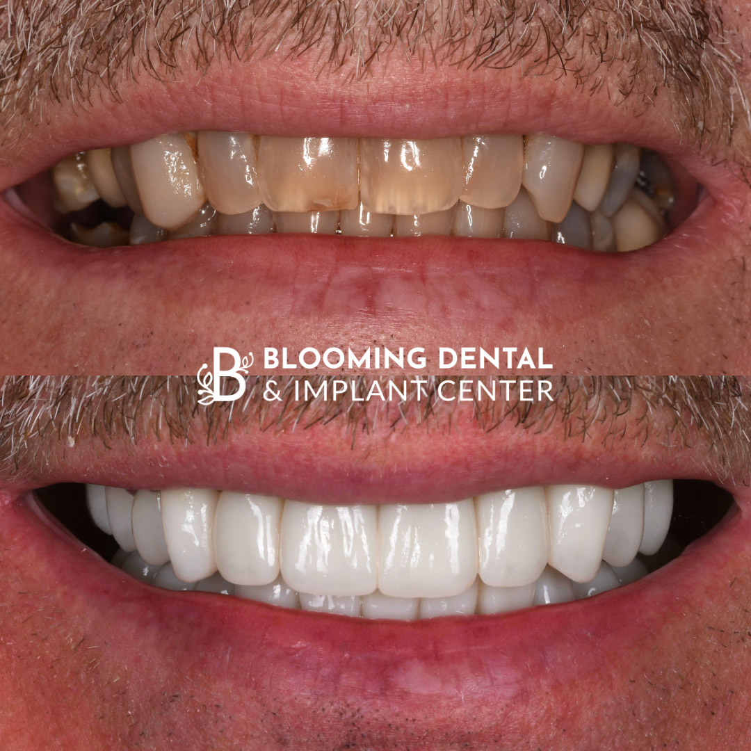 Veneers & FMR Image 17