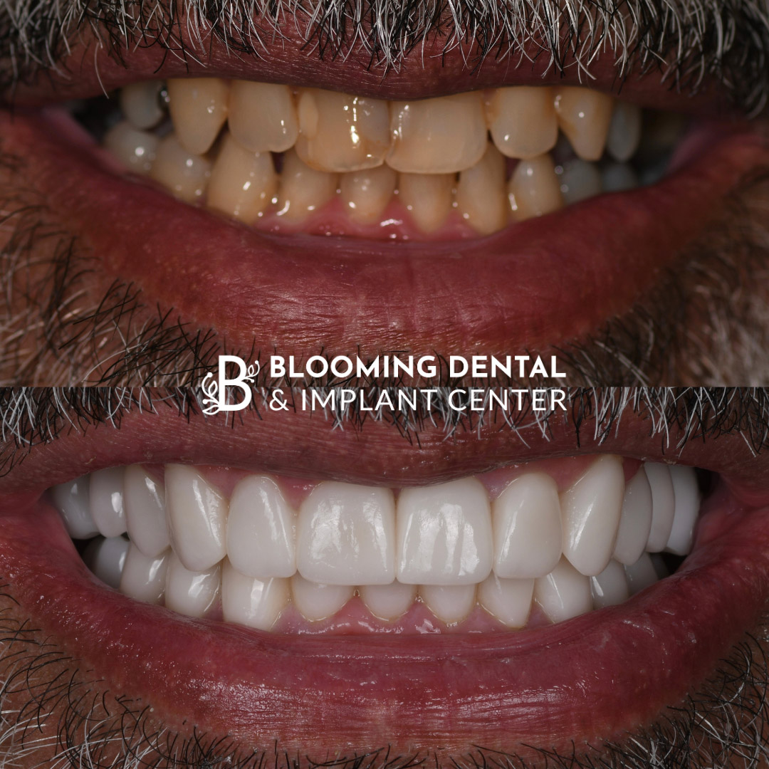 Veneers & FMR Image 18