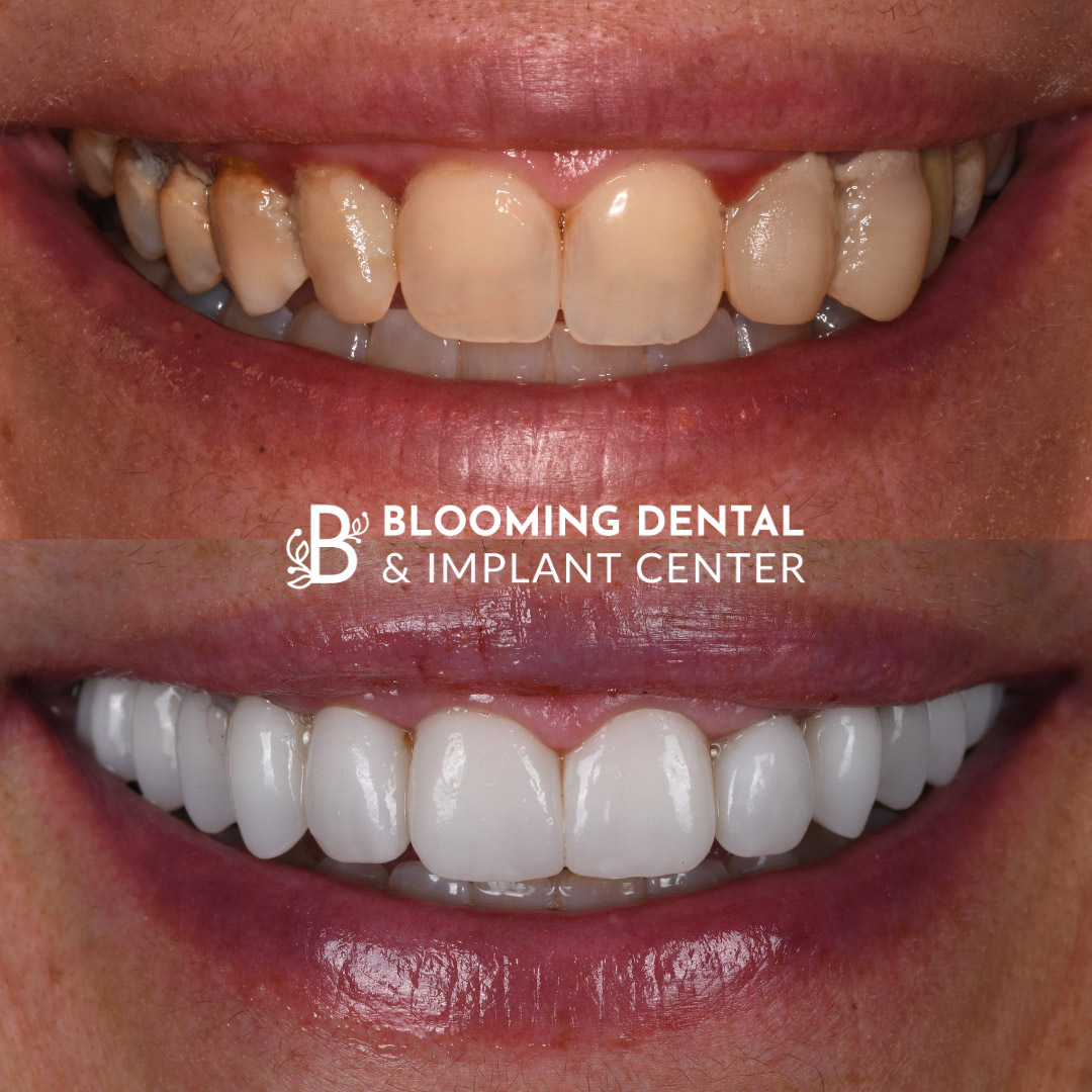 Veneers & FMR Image 19