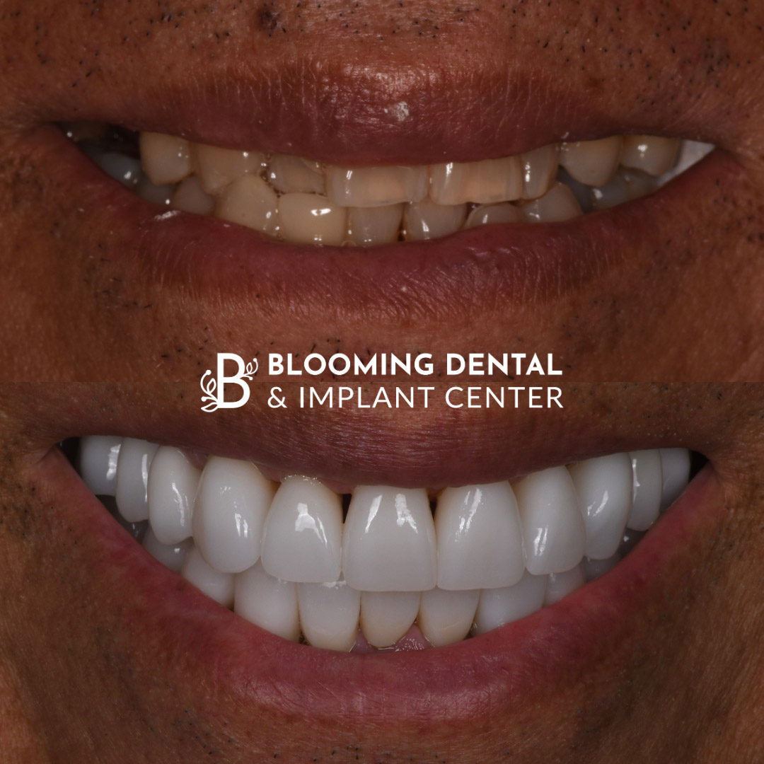 Veneers & FMR Image 20