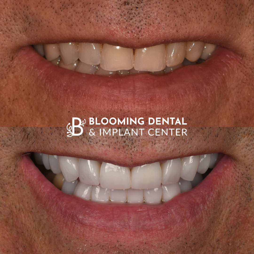 Veneers & FMR Image 21