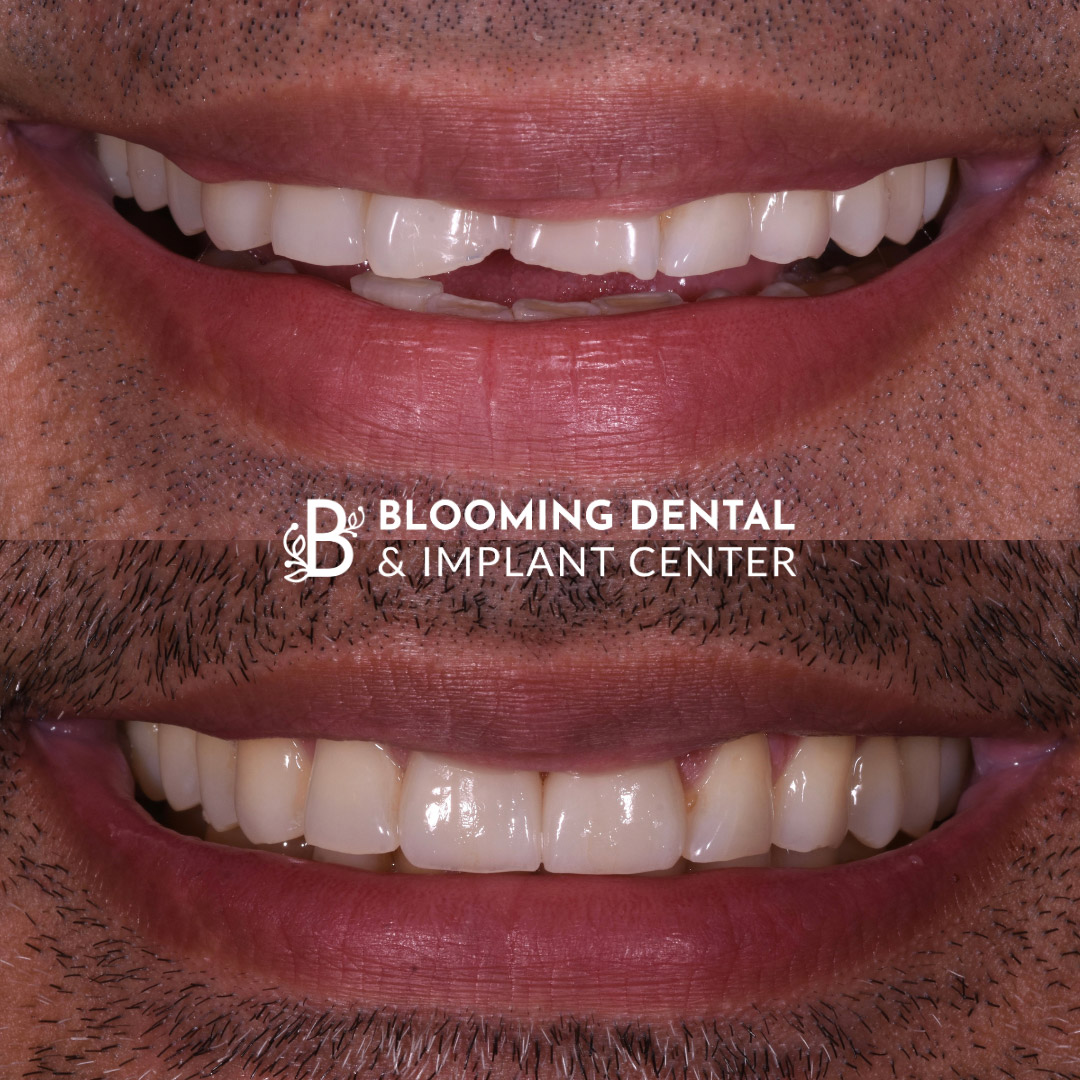 Veneers & FMR Image 6