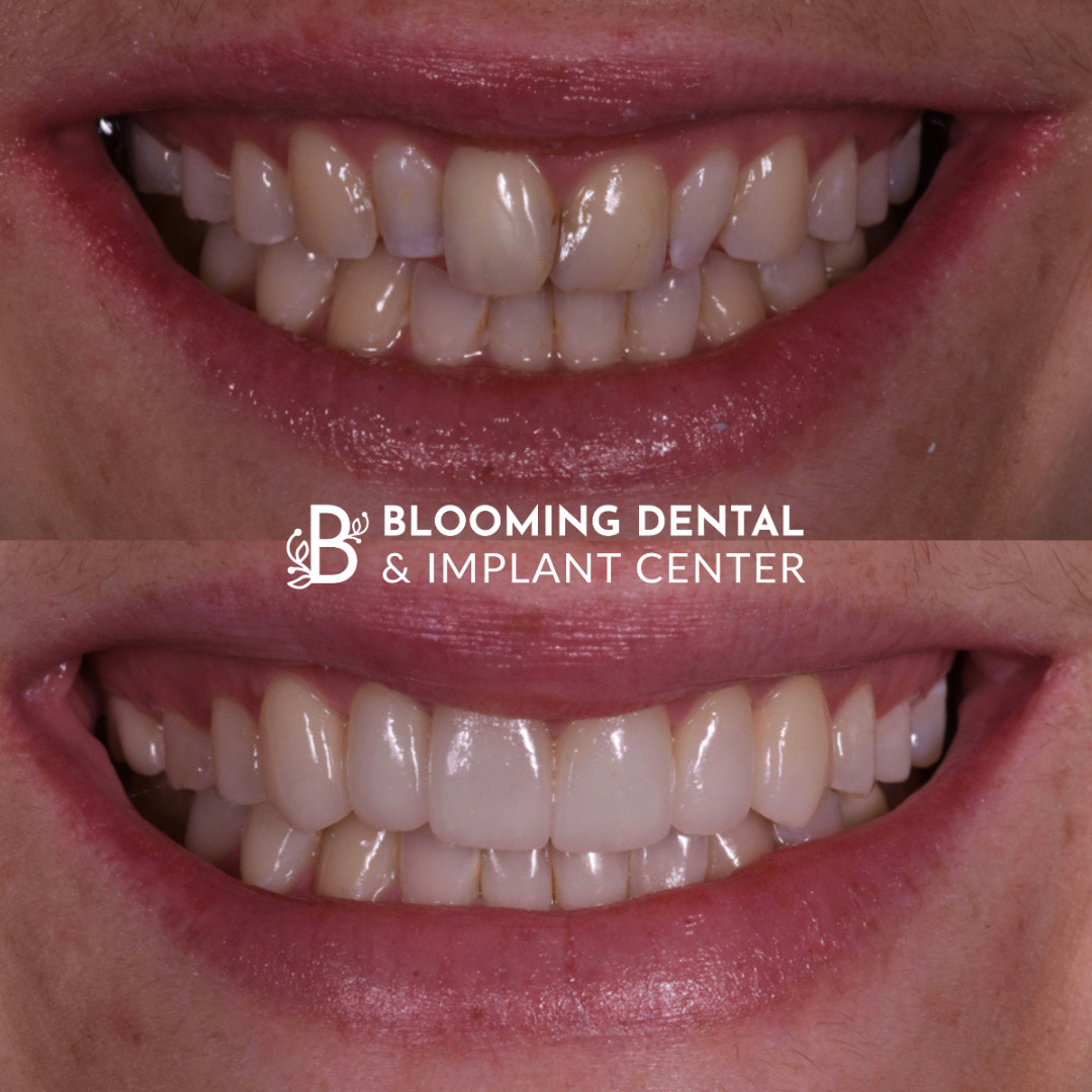 Veneers & FMR Image 7