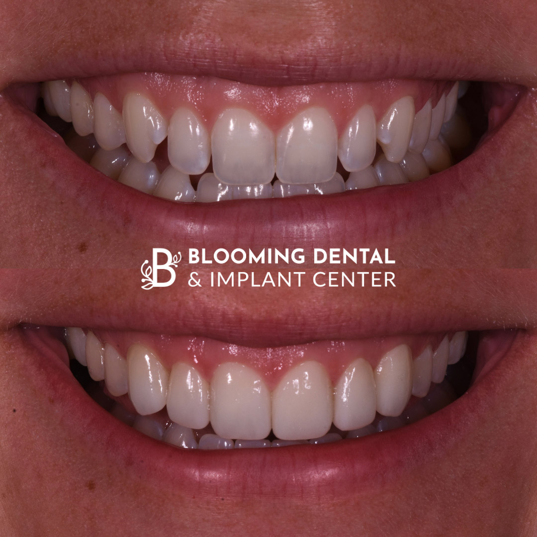 Veneers & FMR Image 8