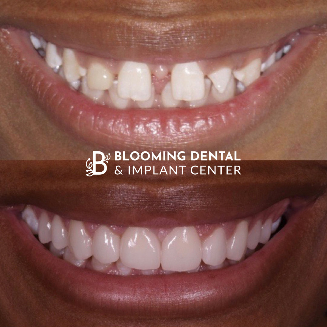 Veneers & FMR Image 9