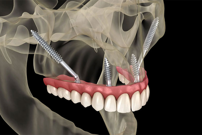 What Are Zygomatic Implants?
