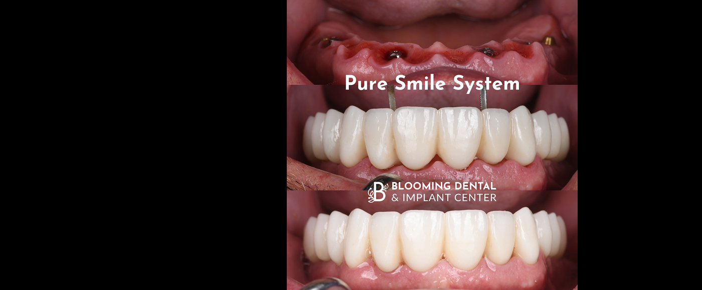 No Bone Reduction: Pure Smile System