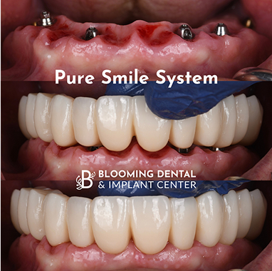 Pure Smile System Implant Bridge
