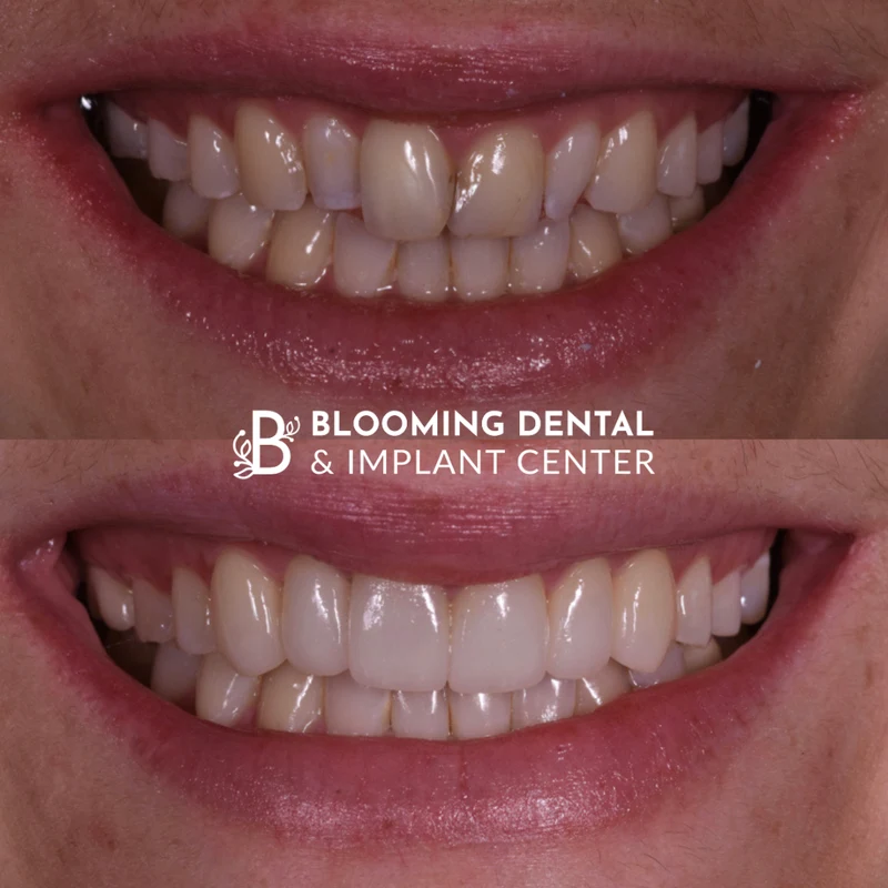 Comprehensive rejuvenation dentistry before and after