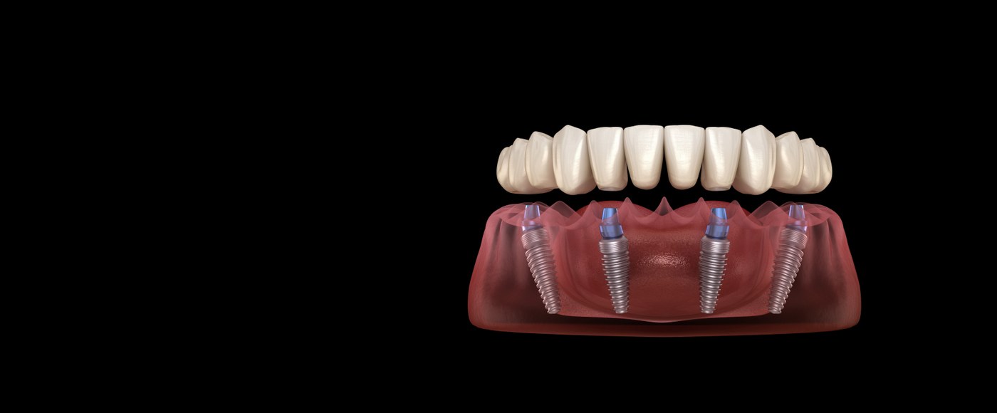 All-On-X full mouth dental implants